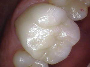 After Dental Crown