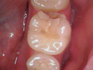 Before Tooth Restoration