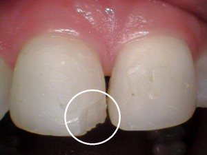 Before Tooth Restoration 2