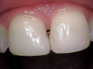 After Tooth Restoration 2