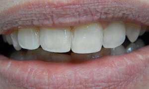 Orthodontic After