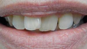 Orthodontic Before