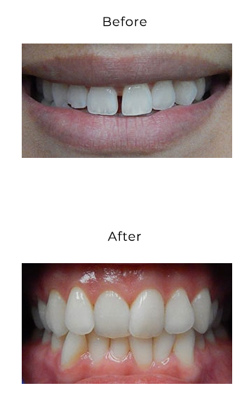 Invisalign Before and After