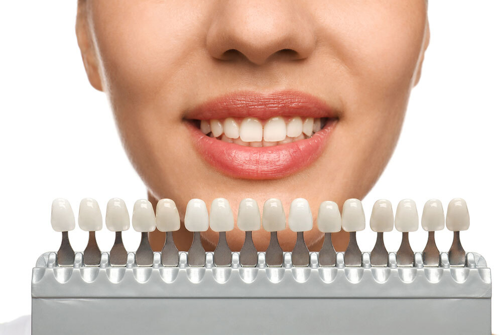 What Makes a Patient a Veneers Candidate?