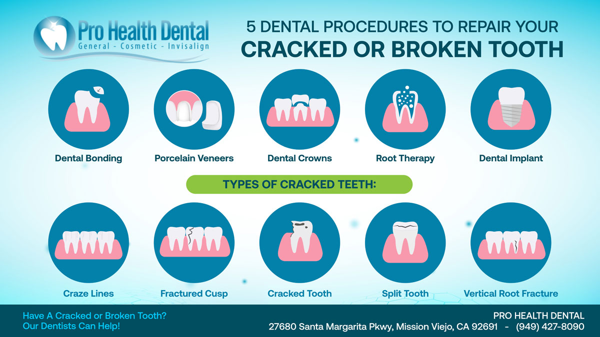 Types of Cracked Teeth and Procedures to Treat Them