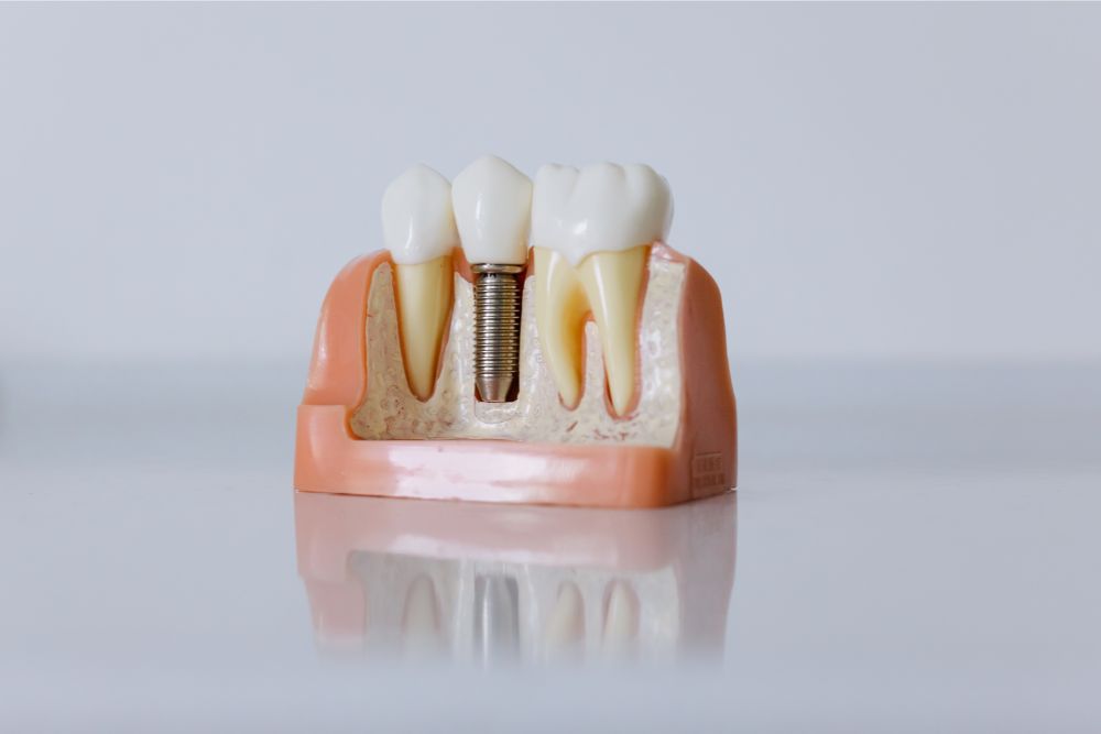 How Can You Identify a Failing Dental Implant?