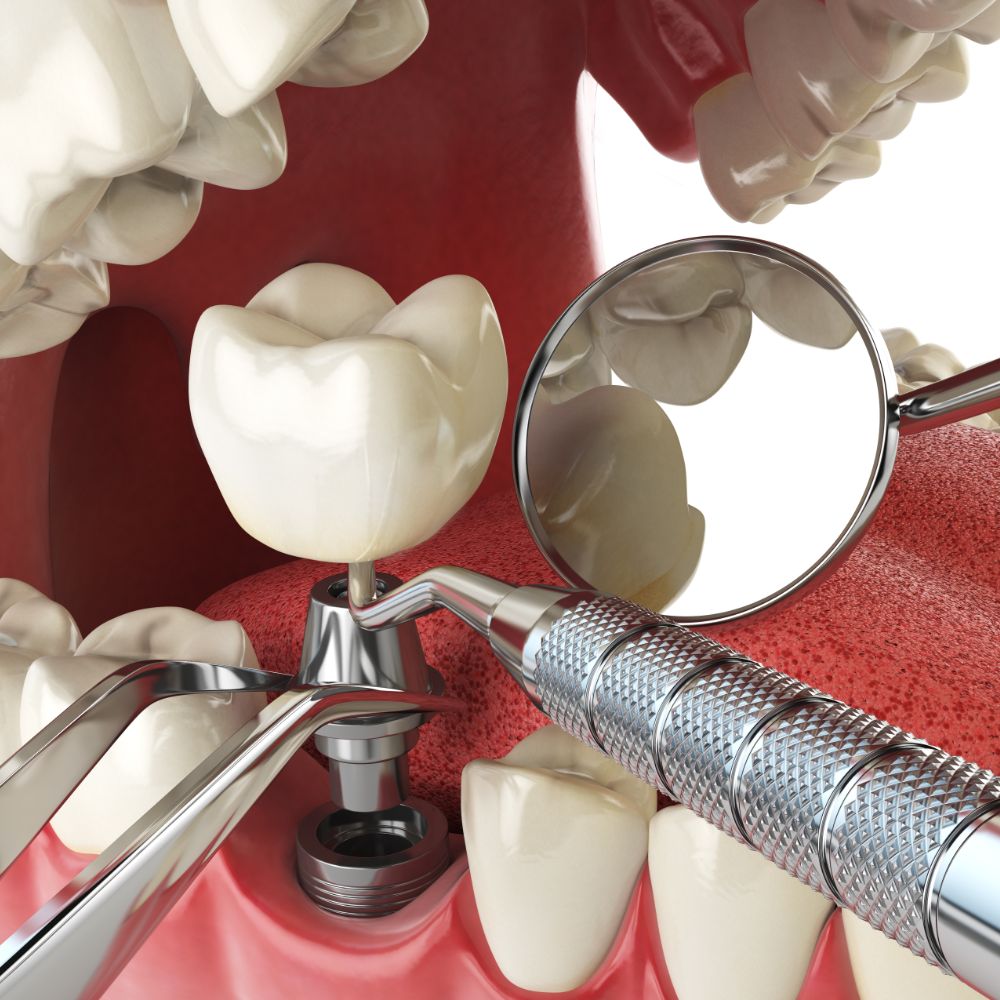 Tips for Cleaning Your Dental Crown